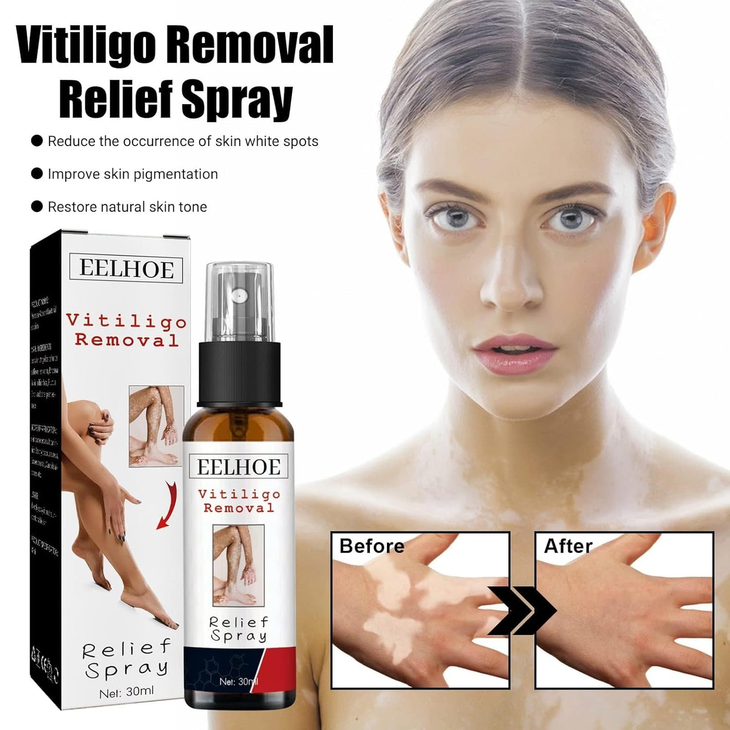 Spray de reparación de piel Vitiligo